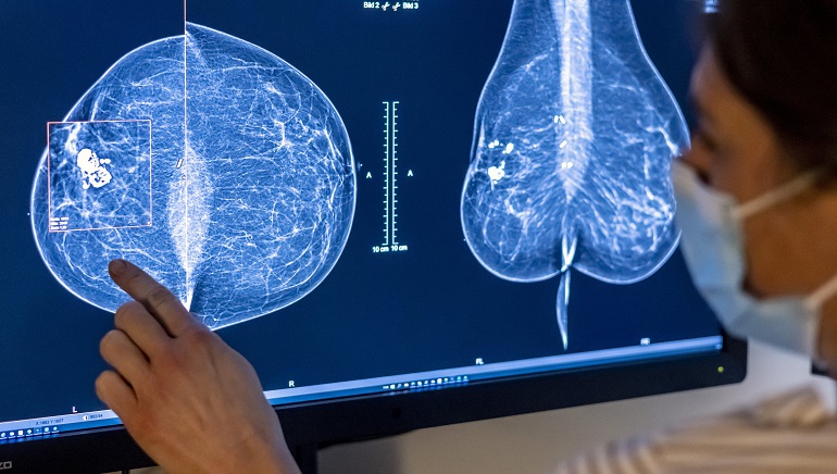 AI Can Detect Breast Cancer as Radiologists, Finds a Study