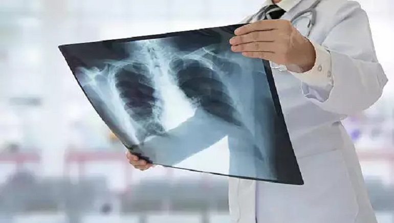 New AI Model Can Estimate Age from Chest X-Rays